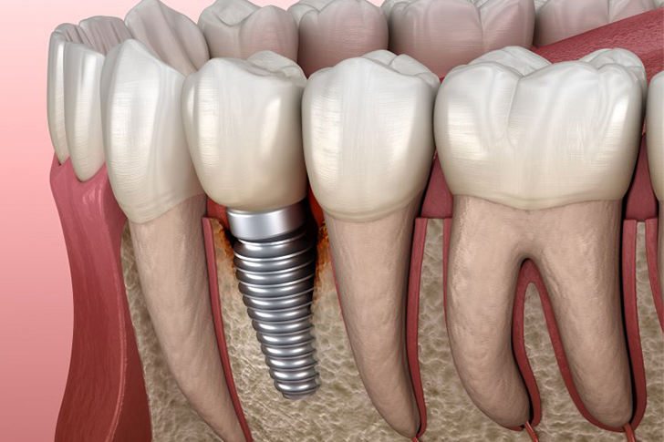 Discover How Seniors Can Obtain Dental Implants Absolutely Affordable!
